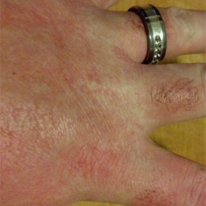 red skin on hand