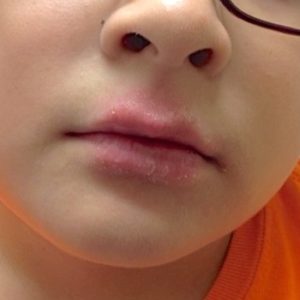 chapped lips and red around lips